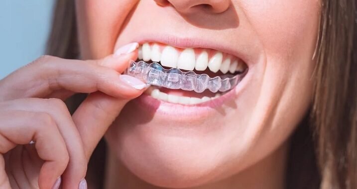 Orthodontic Coverage: What Are Your Options?